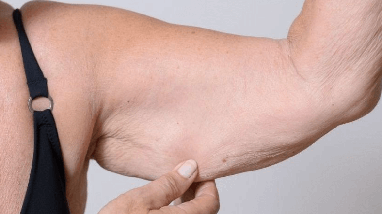 Arm Lift Surgery